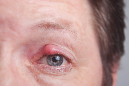 Chalazion