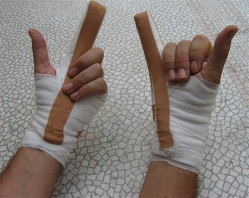 Fracture des doigts