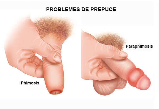 adult balanoposthitis adult balanoposthitis
