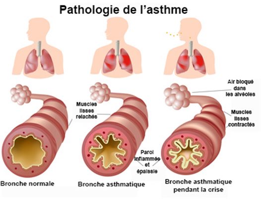 Asthme aigu grave