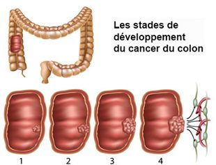 cancer-du-colon