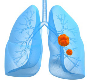 cancer des poumons carcinome