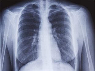 image de radio des poumons