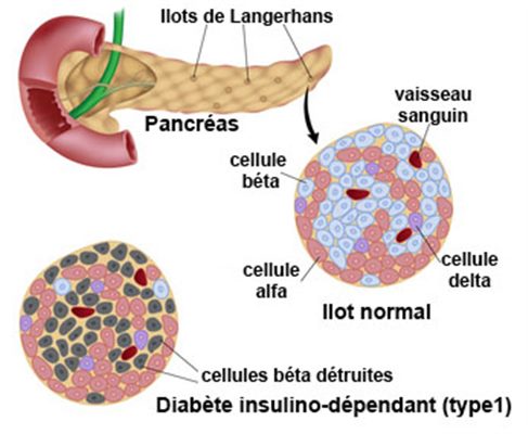 Diabète insulino-dépendant