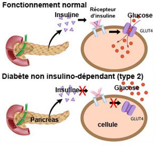 diabète type 2 insulino requérant définition