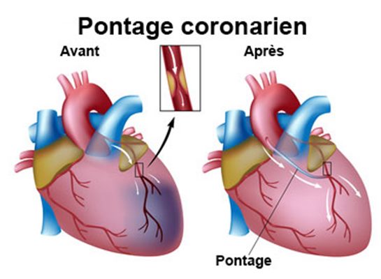 Pontage coronarien