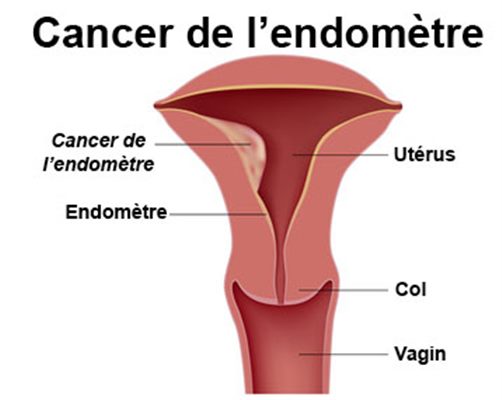 Cancer de l'utérus (endomètre)