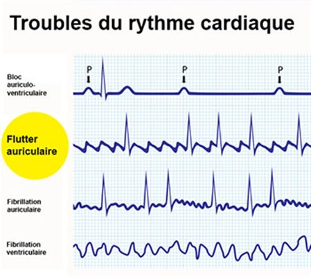 Flutter auriculaire