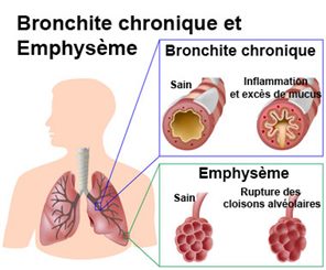 bronchite chronique et emphysème