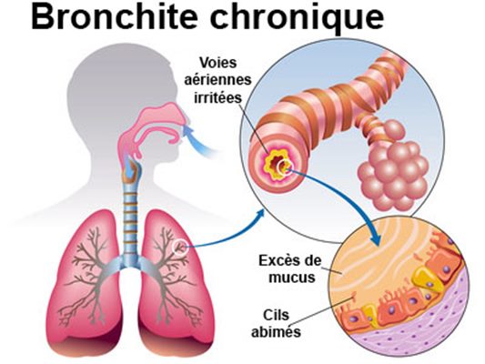 Bronchite chronique