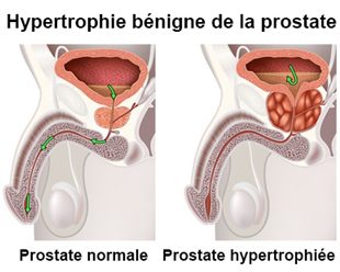 comment soigner prostate trop grosse