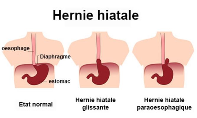 Hernie hiatale