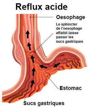 comment traiter le pyrosis