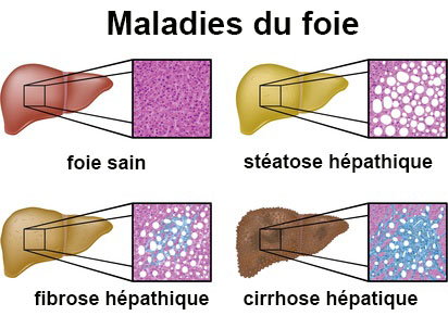 Les lamblias chez krs