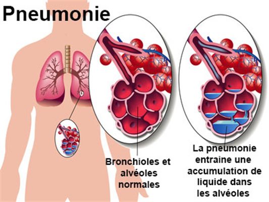 Broncho-pneumonie