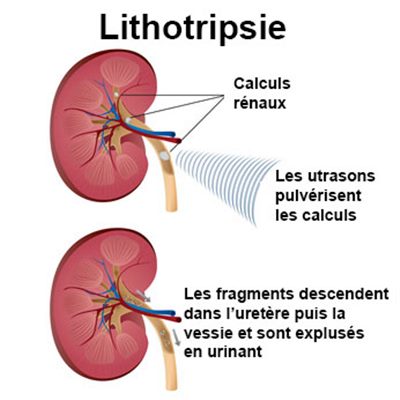 Lithotritie