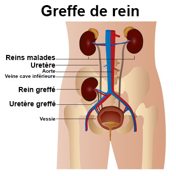 Néphrectomie