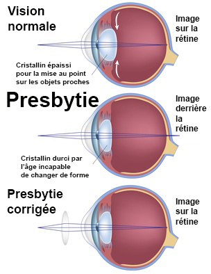 presbytie homeopathie presbytie homeopathie