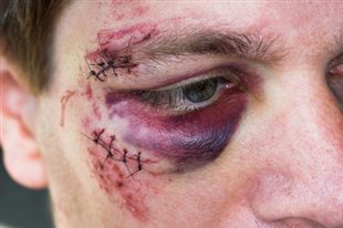 comment soulager un coup d'arc dans les yeux