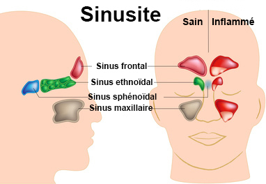 Sinusite
