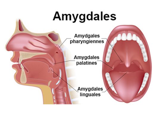 Phlegmon de l'amygdale