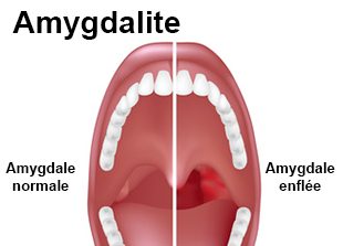 comment traiter amygdalite