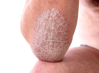 Psoriasis