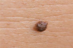 Skin tags | DermNet New Zealand