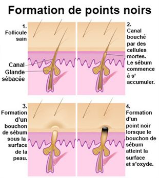 comment traiter les points noirs sur le nez