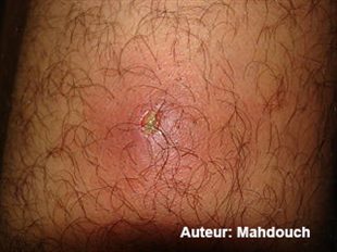 comment soigner furoncle ventre