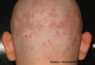 Atopitchesky la dermatite chez jorka