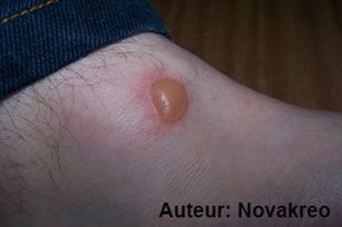 quel insecte piqure cloque