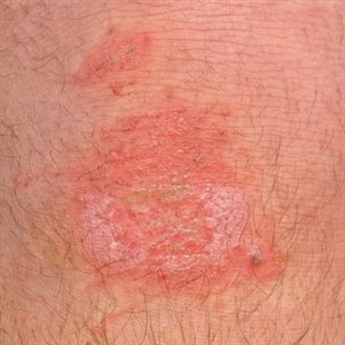 La clinique selon le blanchiment de la peau