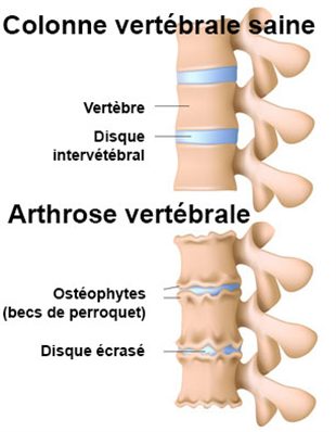 comment traiter arthrose lombaire
