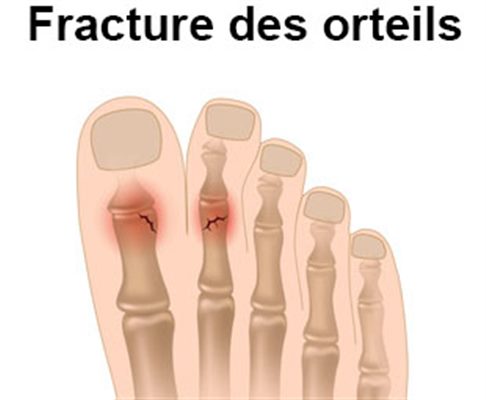 Fracture de l'orteil