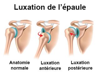 comment guerir une luxation de l'epaule