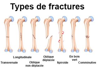 Fractures osseuses fractures de l'os fractures des os os fractures