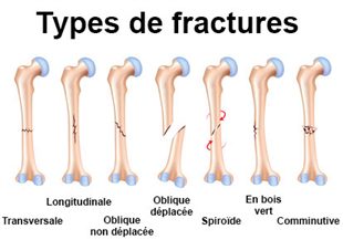 comment guerir d'une fracture fatigue