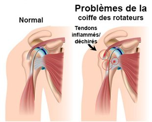 comment soigner rupture coiffe rotateurs