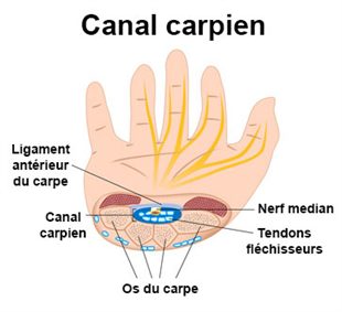 comment traiter syndrome canal carpien