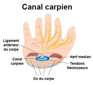 Syndrome du canal carpien : symptômes , traitement , définition