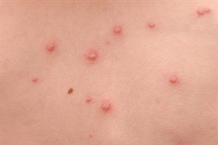 comment traiter la varicelle chez l'adulte