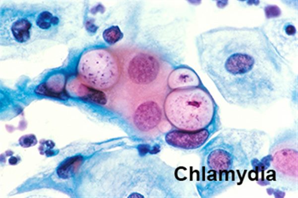 Chlamydia sexuellement transmissible