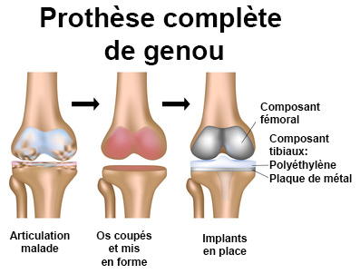 Prothèses articulaires