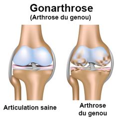 arthrose du genou