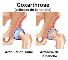 arthrose de la hanche