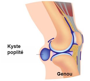 comment soigner kyste synovial genou