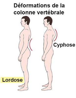 comment traiter lordose