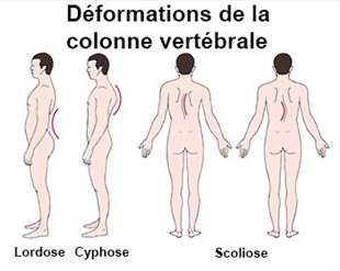 Les métastases du service de poitrine de lépine dorsale