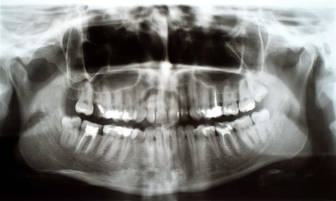 Traumatisme des dents (rando, trek, montagne)
